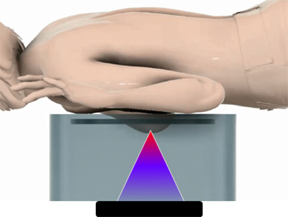 リングエコーに取り付けた集束超音波治療器による治療イメージ